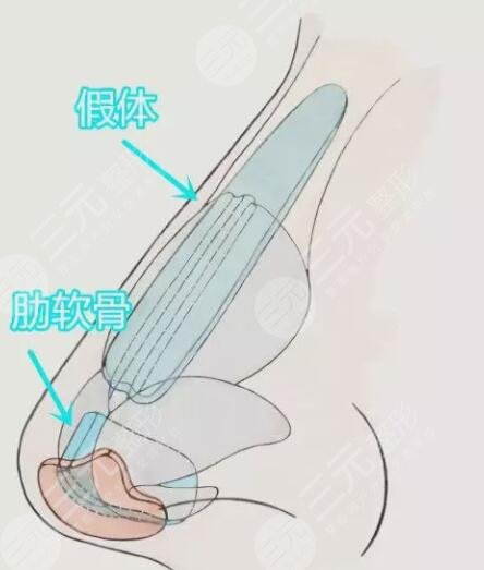 隆鼻整形手术