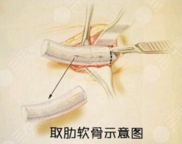 肋软骨隆鼻的注意事项