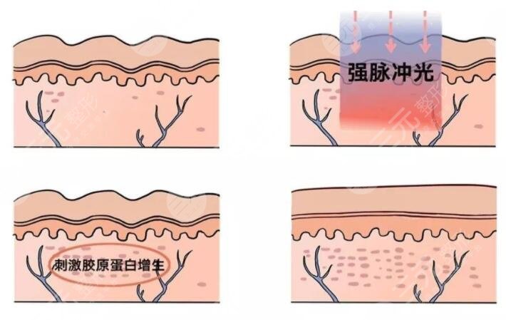 光动力激光缓解有没有副作用?