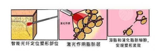 脸部吸脂术后要注意什么？