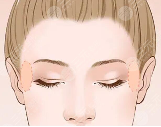 丰太阳穴多少钱2023年?术式方法、医院规模、医生实力都影响着价格收费!