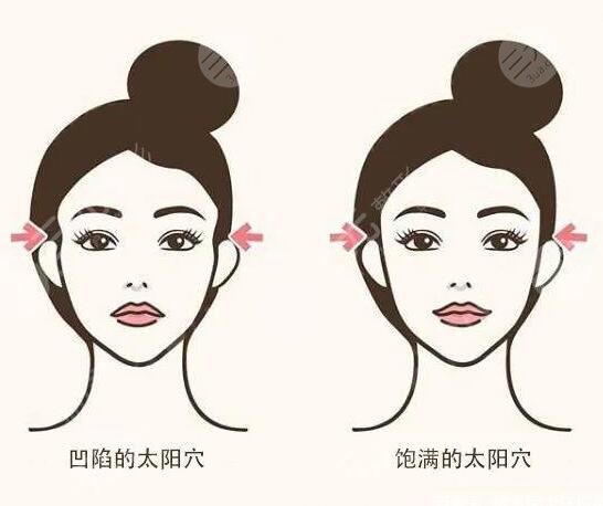 丰太阳穴多少钱价格影响因素有哪些?