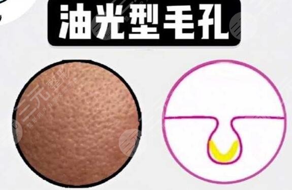 男性毛孔粗大怎么办?