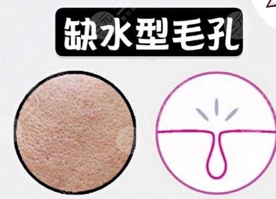 男性毛孔粗大怎么办?