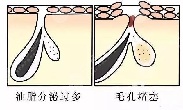 男性毛孔粗大怎么办?