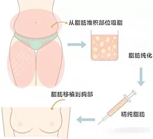 抽脂丰胸是什么原理呢?
