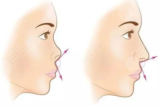 硅胶隆鼻的副作用和危害有哪些?