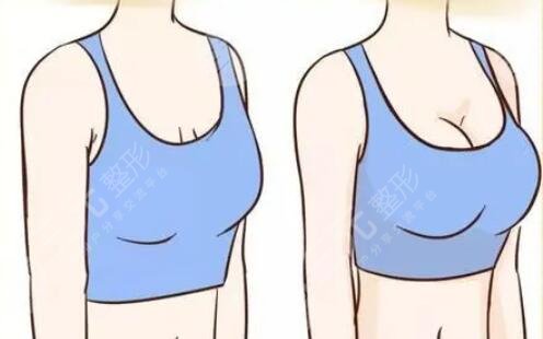 自体脂肪填充胸部