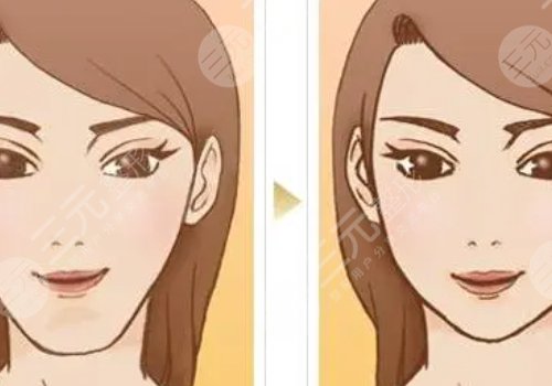 做了下巴整形手术之后需要注意什么?