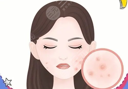 激光祛痘坑痘印有没有危害?