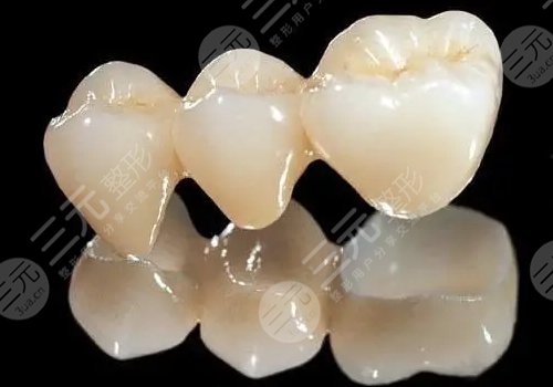 假牙材料有哪几种类型？种植牙、活动义齿等各不相同！抢先看~