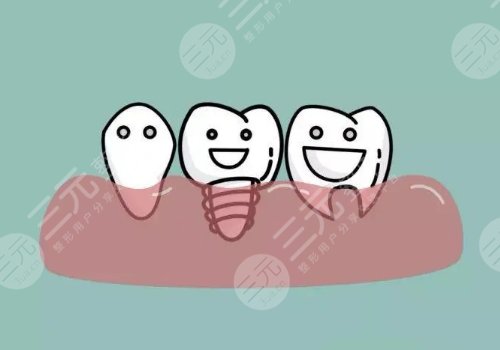 种植牙有什么风险和后遗症？多少钱一颗？缺牙修复必看指南！