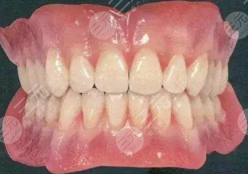 种植牙有什么风险和后遗症?