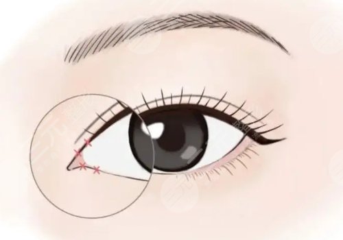 开内眼角一般多少钱?