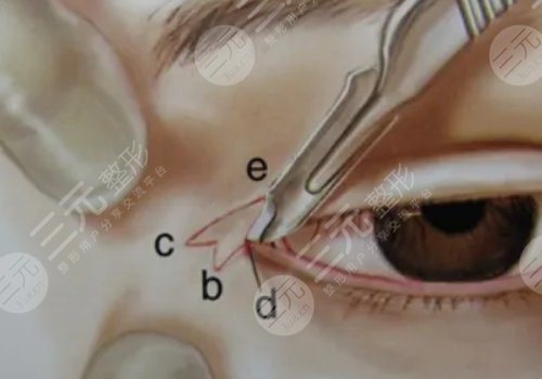 影响开内眼角手术价格的因素有哪些?