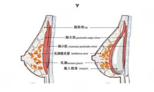麦格假体丰胸的价格是多少?