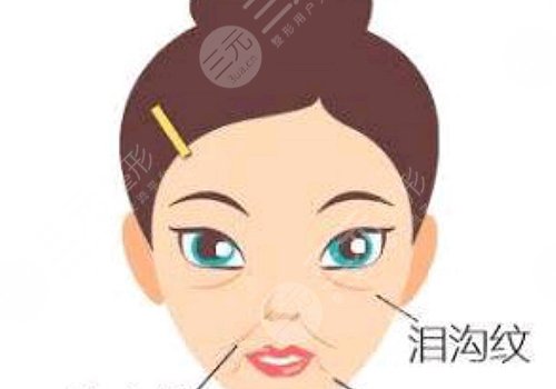 泪沟填充可以维持多久？玻尿酸、自体脂肪各不相同！