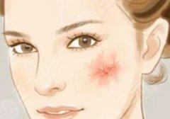 脸颊红血丝怎么办，如何修复？3个方案教你解决，重拾细腻无暇！