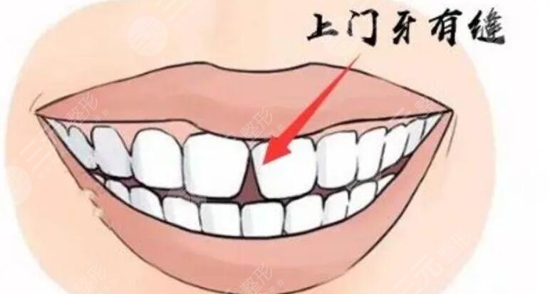 门牙缝隙