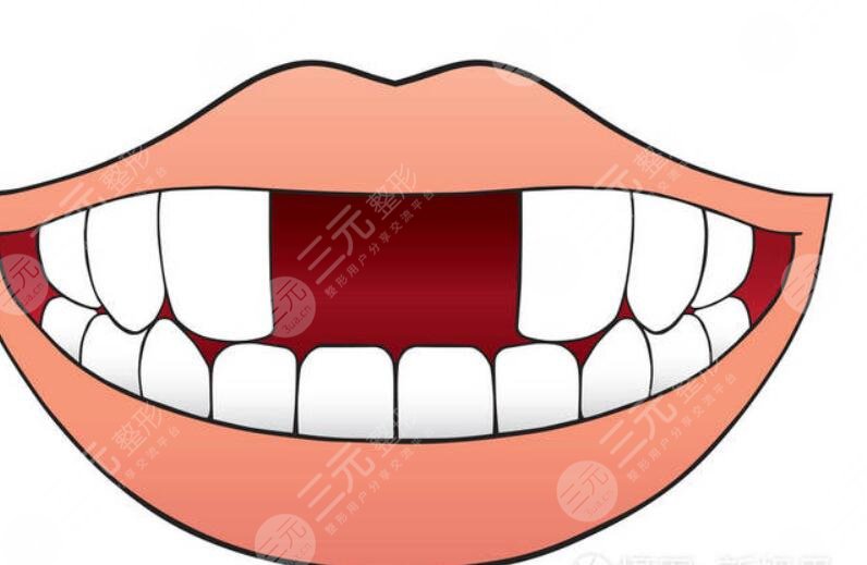门牙缝隙