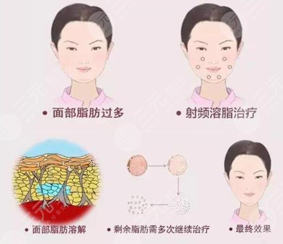 做了镭射溶脂之后需要注意什么?