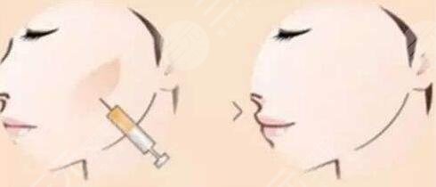 全脸脂肪填充的好处