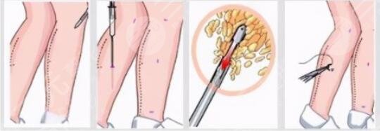 小腿吸脂术效果好吗?