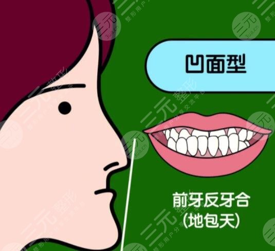 地包天牙齿矫正时间是什么时候?