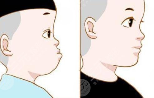 做了地包天矫正之后需要注意什么?