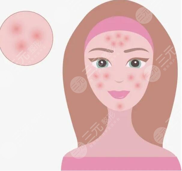 痤疮的缓解方法有哪些？从生活作息、饮食习惯、药物缓解等方面下手！