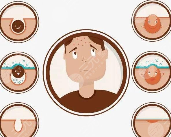 痤疮的缓解方法有哪些?