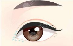 做哪种双眼皮好？双眼皮的形状、手术术式、术后效果分为3大类！