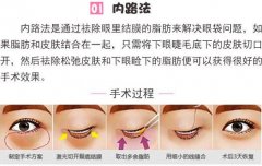 怎样去除眼袋有用？4种医美方式，帮你更快更直接搞定！