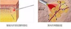 光纤溶脂瘦小腿怎么样？原理、维持时间等预览！肉肉腿必看~