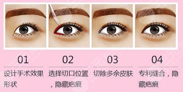 开眼角有危险(风?险)吗?