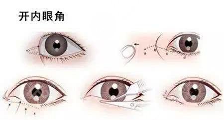 开眼角有危险(风?险)吗?