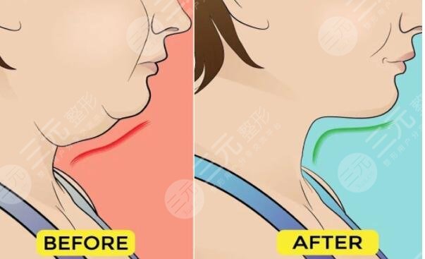 如何消除双下巴和颈纹的方法大全
