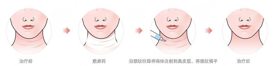 消除双下巴与颈纹的注意事项