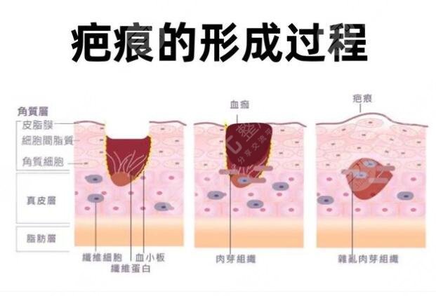疤痕修复手术后恢复期多久?
