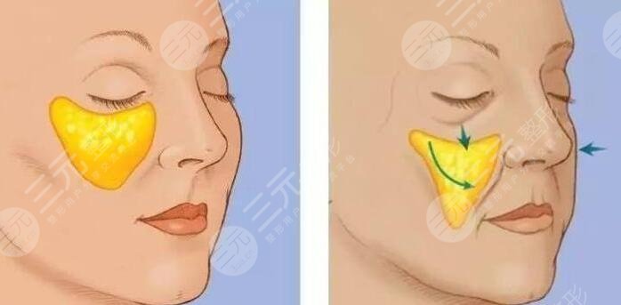 去颊脂垫后遗症可能有哪些?手术原理、风险后遗症、注意事项都有哪些?