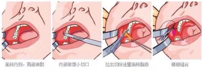 去颊脂垫手术是什么原理?