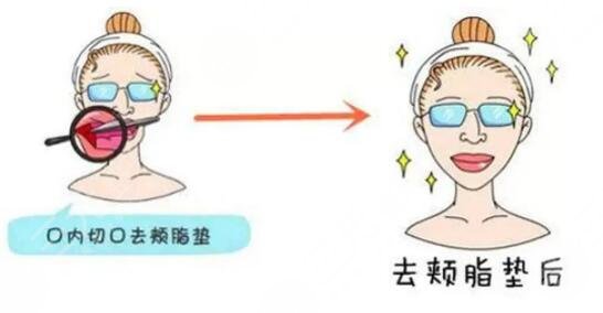 去颊脂垫后遗症可能有哪些?