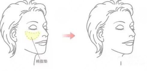 去颊脂垫的注意事项