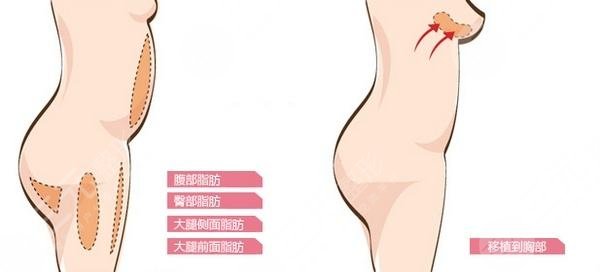 自体脂肪隆胸