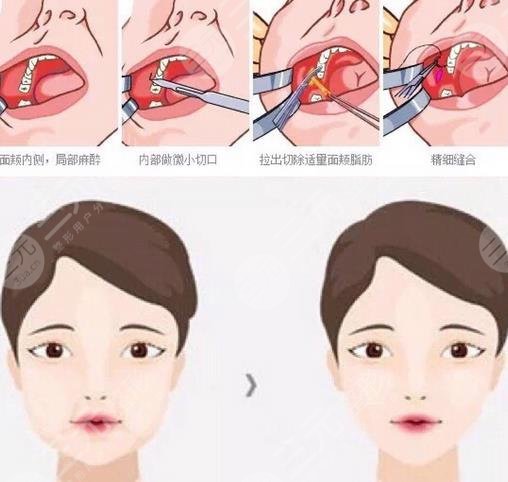 去颊脂垫的原理?是什么?