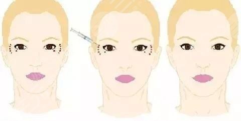 激光除皱|缓解鱼?尾纹的原理是什么?