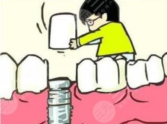 牙齿掉了能种植牙吗？缺牙时间一定不要过长！#修复牙攻略#