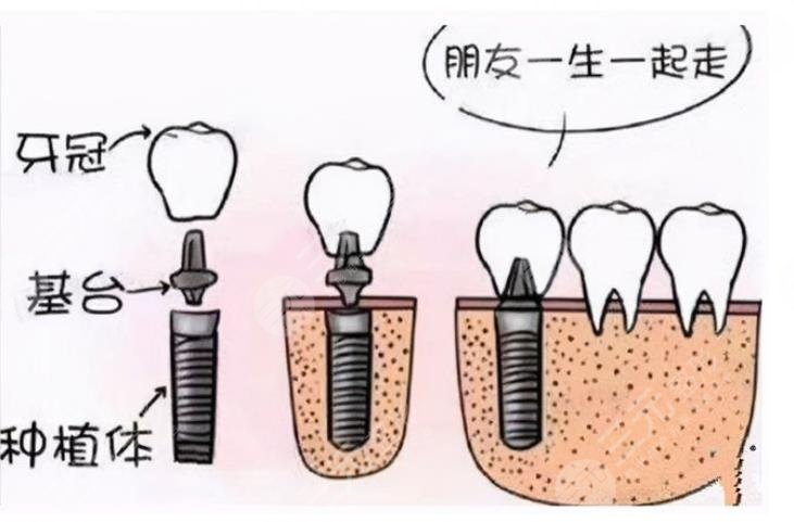 种植牙手术是什?么原理?