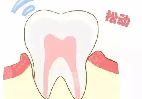 牙齿松动有什么办法恢复?