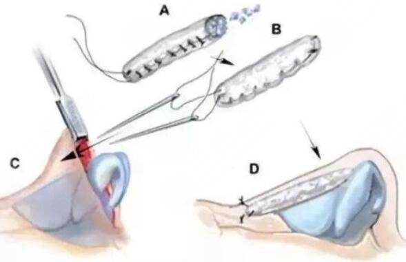 隆鼻需要多长时间恢复?